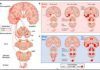 Resuelven el misterio de la asimetría motora en el mal de Parkinson Resuelven el misterio de la asimetría motora en el mal de Parkinson