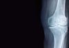 Novedoso biomarcador de imágenes con IA para la osteoartritis de rodilla Novedoso biomarcador de imágenes con IA para la osteoartritis de rodilla