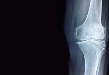 Novedoso biomarcador de imágenes con IA para la osteoartritis de rodilla Novedoso biomarcador de imágenes con IA para la osteoartritis de rodilla