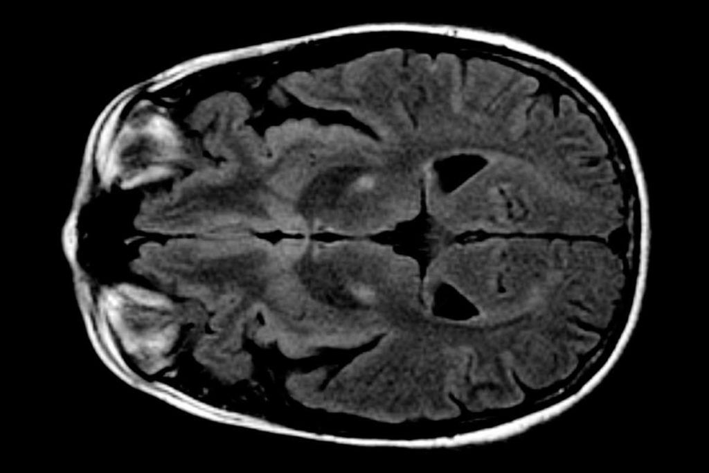 Identifican un nuevo gen que puede aumentar el riesgo de ELA
