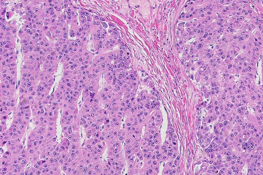 Avances contra un infrecuente cáncer de hígado letal en niños y jóvenes