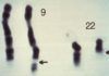 Dra. Bendala: La historia oculta y veraz del cromosoma Filadelfia Dra. Bendala: La historia oculta y veraz del cromosoma Filadelfia
