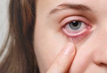 Detectan anemia con una foto del párpado tomada con el móvil Detectan anemia con una foto del párpado tomada con el móvil
