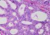 Nueva diana para combatir el cáncer de próstata agresivo Nueva diana para combatir el cáncer de próstata agresivo
