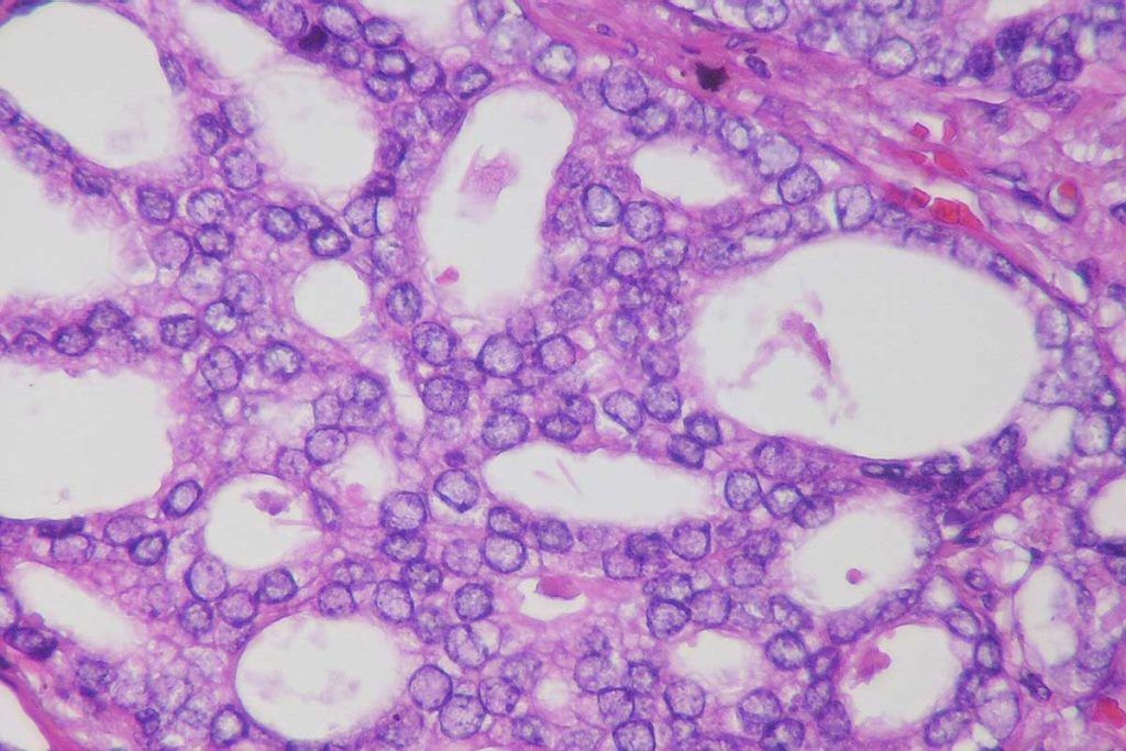 Nueva diana para combatir el cáncer de próstata agresivo