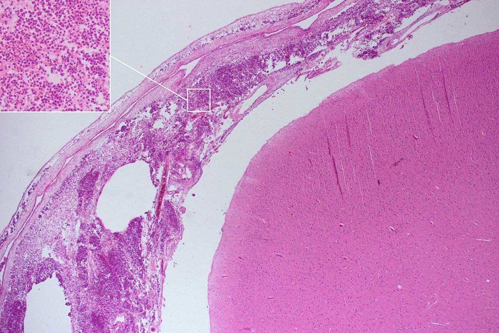 Descubren cómo algunas bacterias de la meningitis evaden el sistema inmune