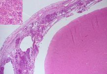 Descubren cómo algunas bacterias de la meningitis evaden el sistema inmune Descubren cómo algunas bacterias de la meningitis evaden el sistema inmune