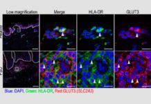 Un nuevo tipo de células contribuye a la aparición de psoriasis Un nuevo tipo de células contribuye a la aparición de psoriasis