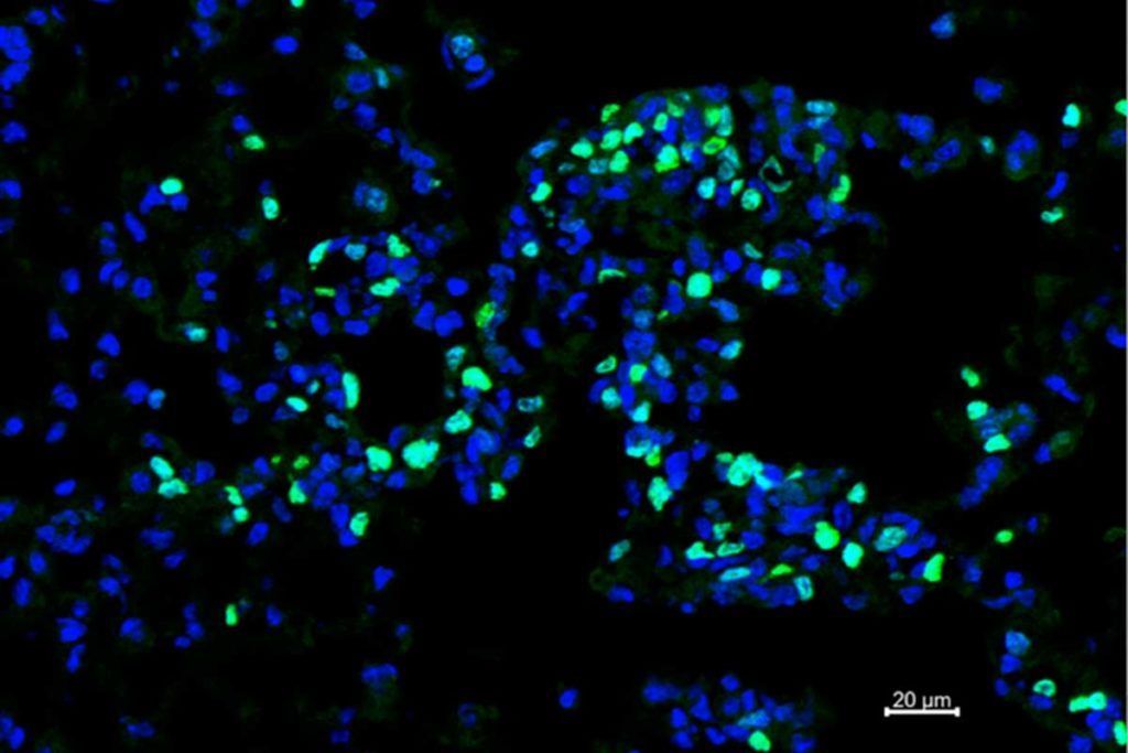 Una clase de glóbulos blancos ayuda a combatir el cáncer