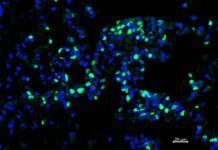 Una clase de glóbulos blancos ayuda a combatir el cáncer Una clase de glóbulos blancos ayuda a combatir el cáncer