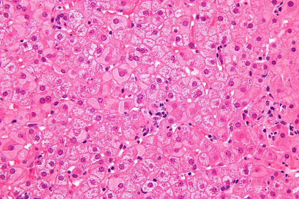 El virus B de la hepatitis estaba presente en Europa hace 10.000 años