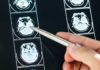 El Alzheimer aparece a la vez en varias zonas del cerebro El Alzheimer aparece a la vez en varias zonas del cerebro
