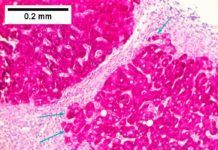 Hallan un ‘escudo natural’ frente a la infección del virus C de la hepatitis Hallan un ‘escudo natural’ frente a la infección del virus C de la hepatitis