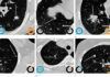 Detectan con Inteligencia Artificial el riesgo de padecer cáncer de pulmón Detectan con Inteligencia Artificial el riesgo de padecer cáncer de pulmón