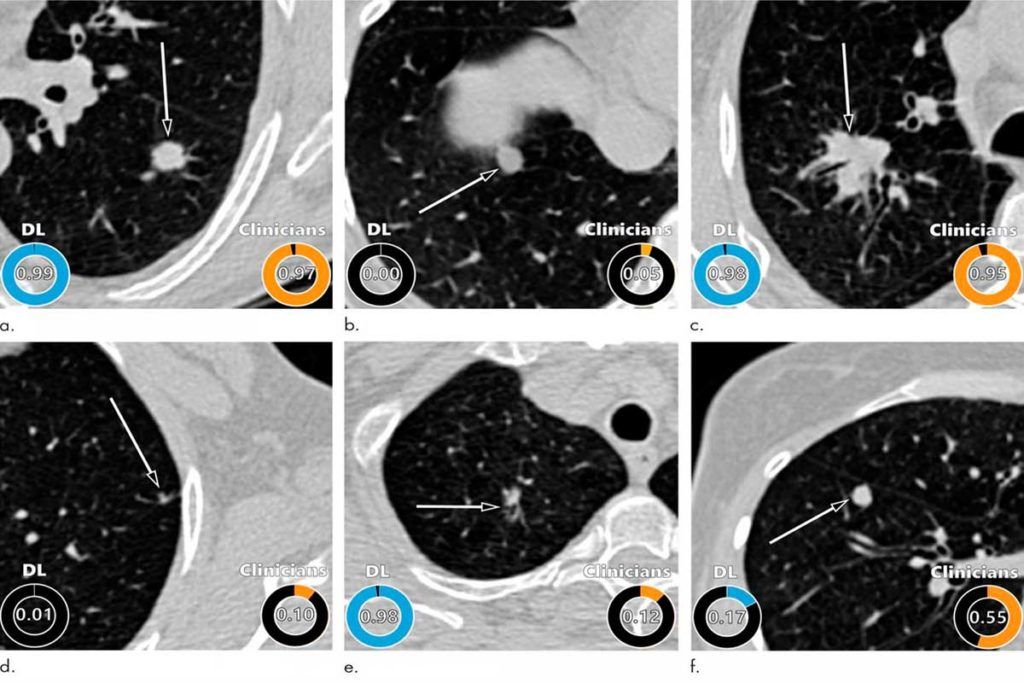 Detectan con Inteligencia Artificial el riesgo de padecer cáncer de pulmón