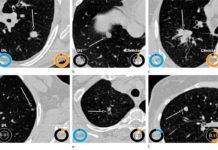 Detectan con Inteligencia Artificial el riesgo de padecer cáncer de pulmón Detectan con Inteligencia Artificial el riesgo de padecer cáncer de pulmón