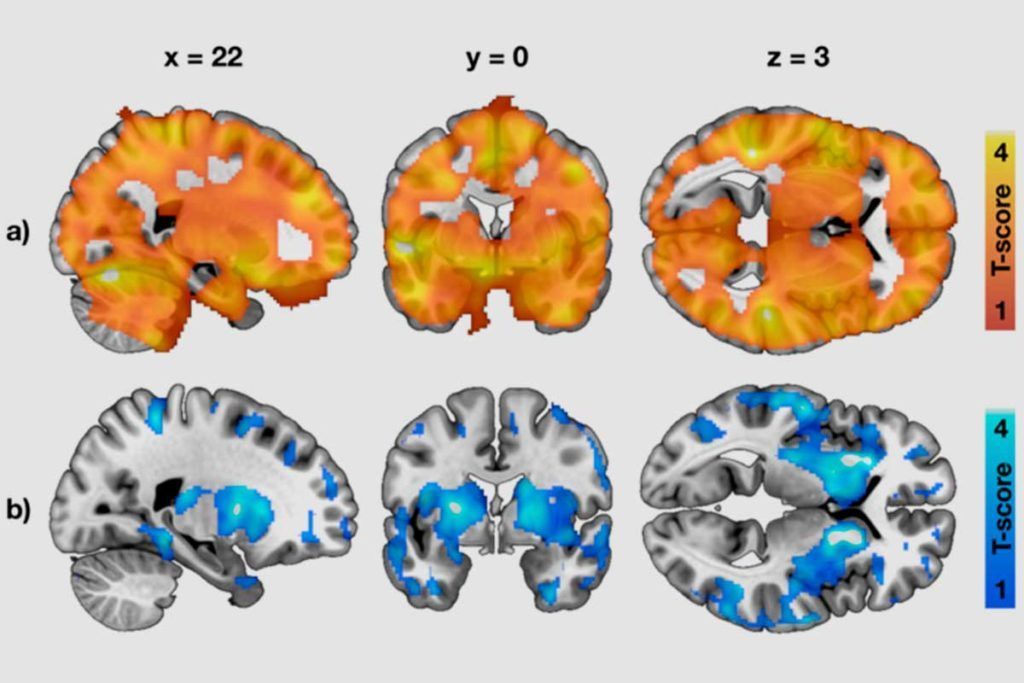 El cerebro alerta del riesgo de obesidad