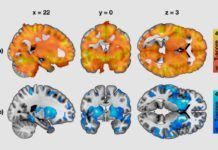 El cerebro alerta del riesgo de obesidad El cerebro alerta del riesgo de obesidad