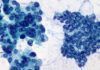 Encuentran posible causa de la agresividad del cáncer de páncreas Encuentran posible causa de la agresividad del cáncer de páncreas