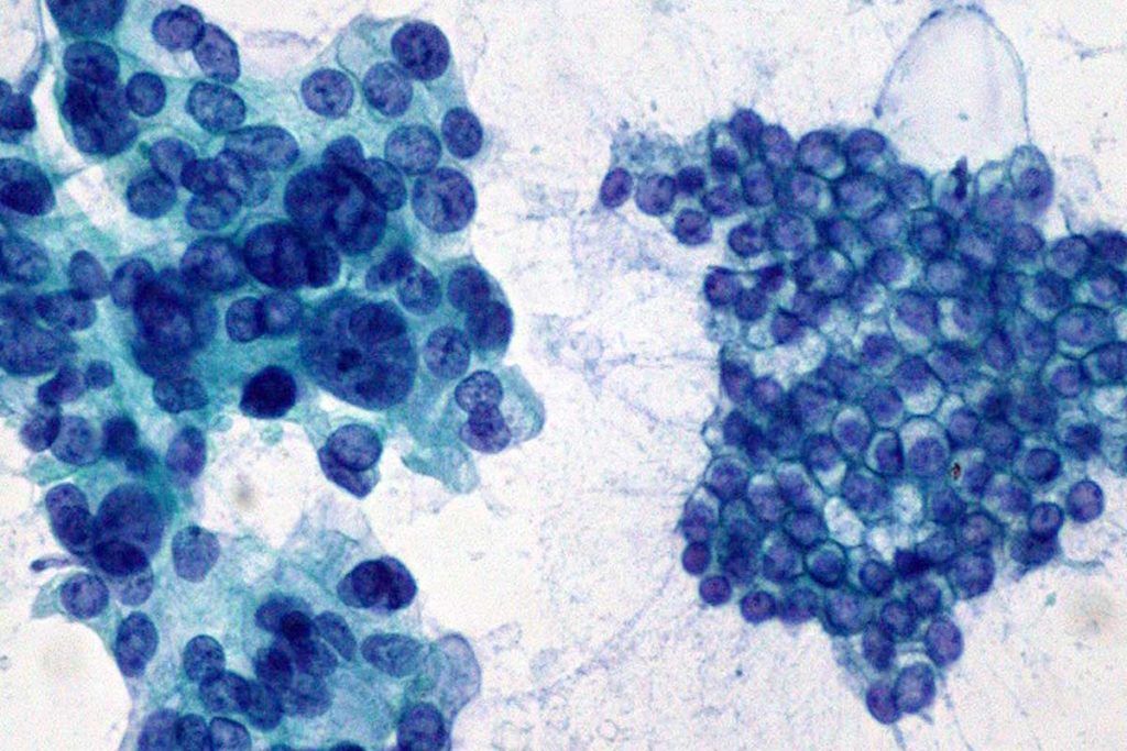 Encuentran posible causa de la agresividad del cáncer de páncreas
