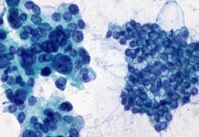 Encuentran posible causa de la agresividad del cáncer de páncreas Encuentran posible causa de la agresividad del cáncer de páncreas
