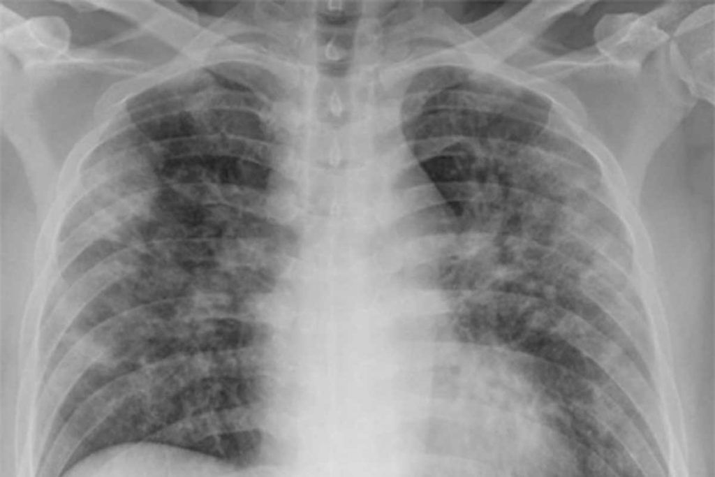 Nueva cara de la pandemia: ¿de la neumonía grave al catarro molesto?