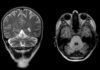 Arrojan luz sobre el síndrome de Gordon-Holmes y otras enfermedades neurodegenerativas raras Arrojan luz sobre el síndrome de Gordon-Holmes y otras enfermedades neurodegenerativas raras