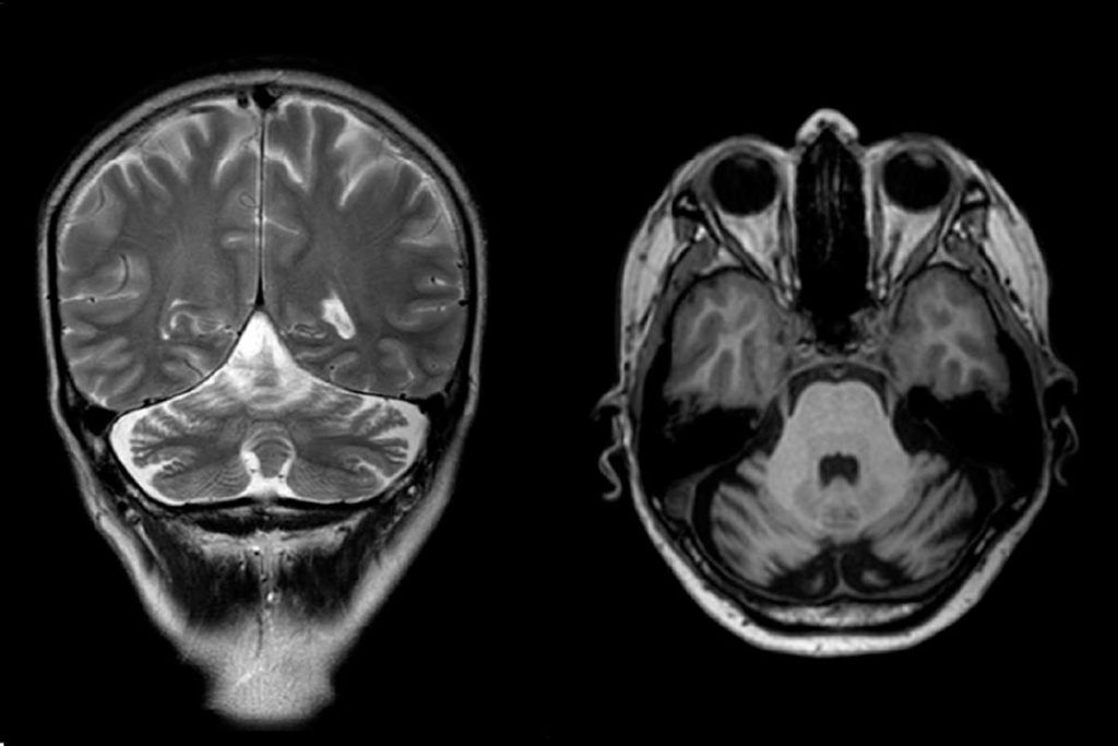 Arrojan luz sobre el síndrome de Gordon-Holmes y otras enfermedades neurodegenerativas raras