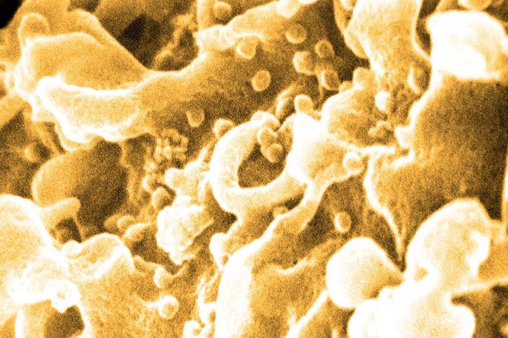 Detectan una nueva variante más agresiva del VIH del sida