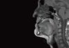 Un antimalárico, eficaz frente a cáncer de cabeza y cuello Un antimalárico, eficaz frente a cáncer de cabeza y cuello
