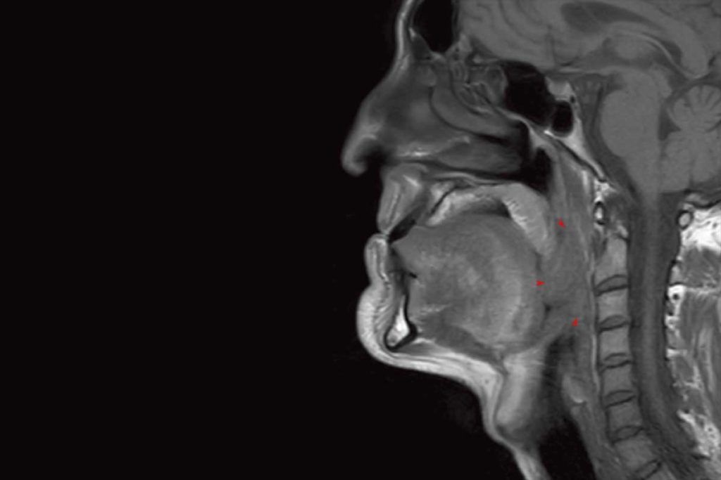 Un antimalárico, eficaz frente a cáncer de cabeza y cuello