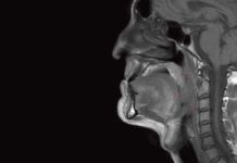 Un antimalárico, eficaz frente a cáncer de cabeza y cuello Un antimalárico, eficaz frente a cáncer de cabeza y cuello