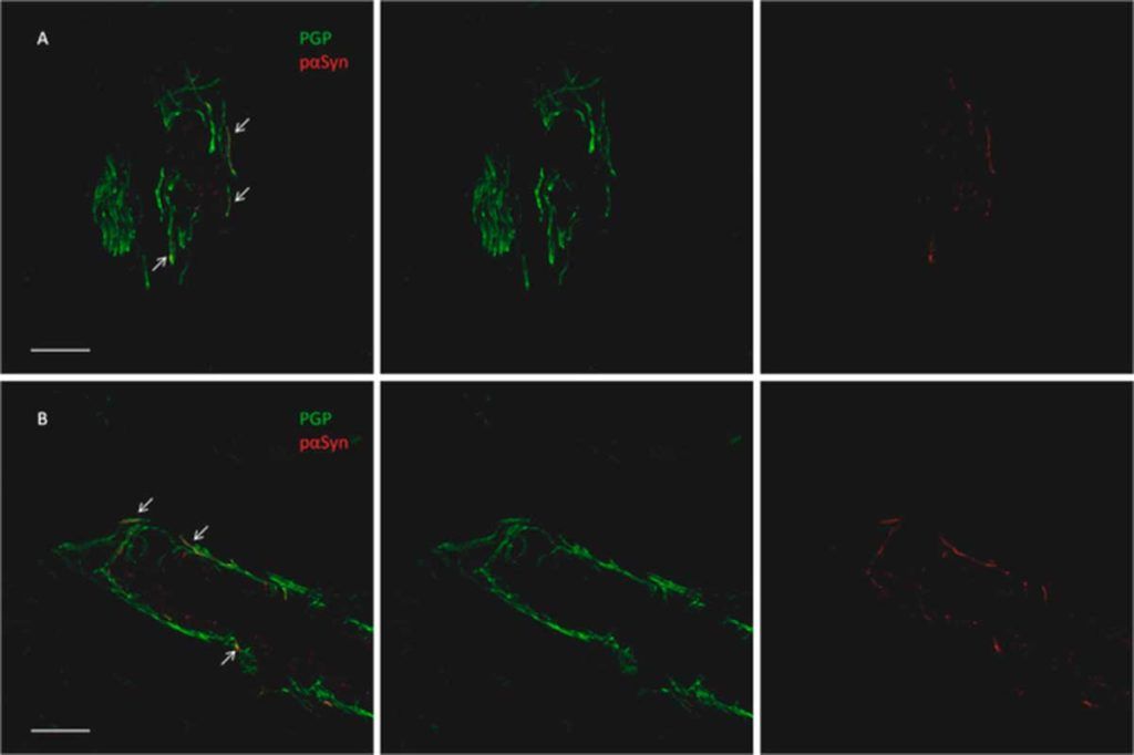 Biopsia de piel para identificar Parkinson