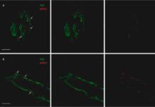 Biopsia de piel para identificar Parkinson Biopsia de piel para identificar Parkinson