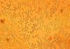 Vinculan al virus del herpes con trastornos neurodegenerativos Vinculan al virus del herpes con trastornos neurodegenerativos