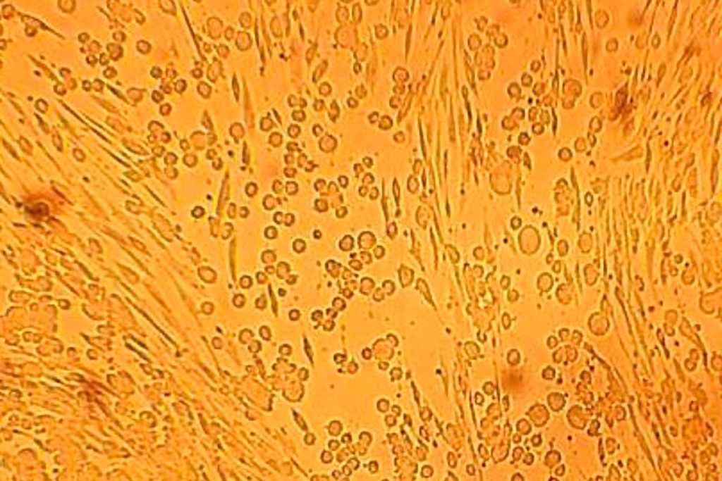 Vinculan al virus del herpes con trastornos neurodegenerativos