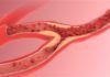 Un nuevo método detecta precozmente la aterosclerosis Un nuevo método detecta precozmente la aterosclerosis