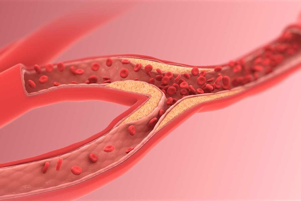 Un nuevo método detecta precozmente la aterosclerosis