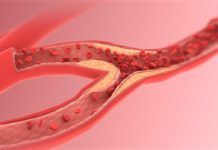 Un nuevo método detecta precozmente la aterosclerosis Un nuevo método detecta precozmente la aterosclerosis