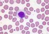 Auto ataque del sistema inmune en un tipo raro de leucemia Auto ataque del sistema inmune en un tipo raro de leucemia