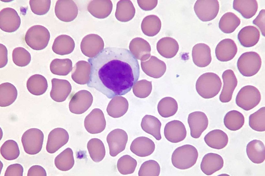 Auto ataque del sistema inmune en un tipo raro de leucemia