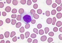 Auto ataque del sistema inmune en un tipo raro de leucemia Auto ataque del sistema inmune en un tipo raro de leucemia