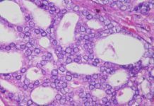 Cambios en una proteína impulsan metástasis en el cáncer de próstata Cambios en una proteína impulsan metástasis en el cáncer de próstata