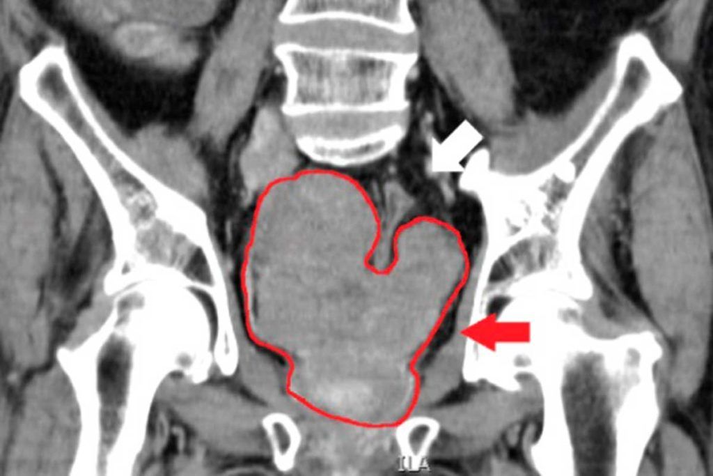 ‘Internet de las cosas’ para detectar cáncer de próstata