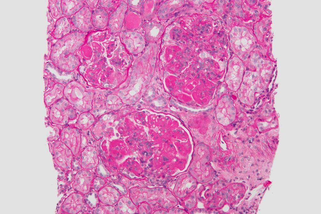 Lupus: nuevos biomarcadores para predecir su progresión
