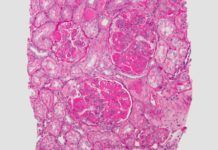 Lupus: nuevos biomarcadores para predecir su progresión Lupus: nuevos biomarcadores para predecir su progresión