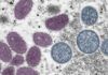 Mayo Clinic utiliza ya la prueba de detección de la viruela del simio Mayo Clinic utiliza ya la prueba de detección de la viruela del simio