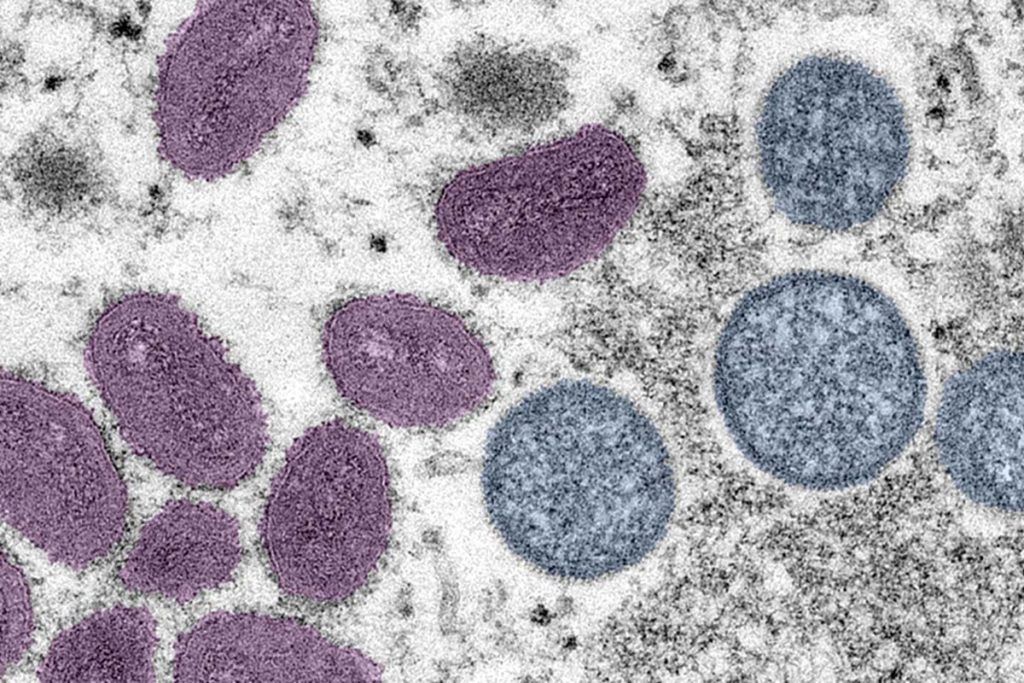 Mayo Clinic utiliza ya la prueba de detección de la viruela del simio