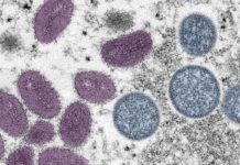 Mayo Clinic utiliza ya la prueba de detección de la viruela del simio Mayo Clinic utiliza ya la prueba de detección de la viruela del simio