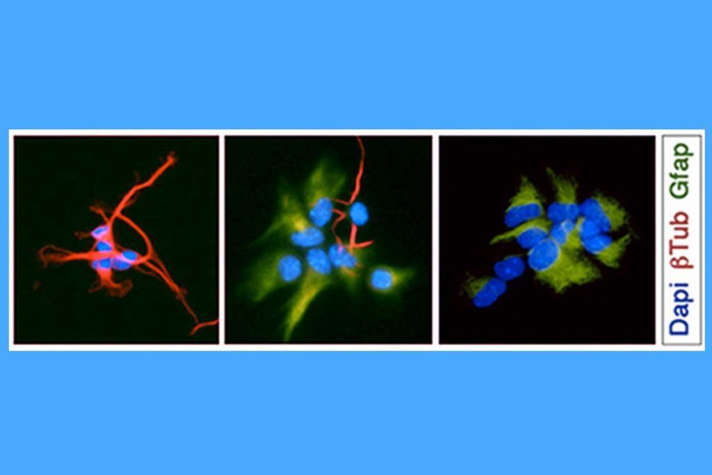 Astrocitos: clave frente al glioblastoma